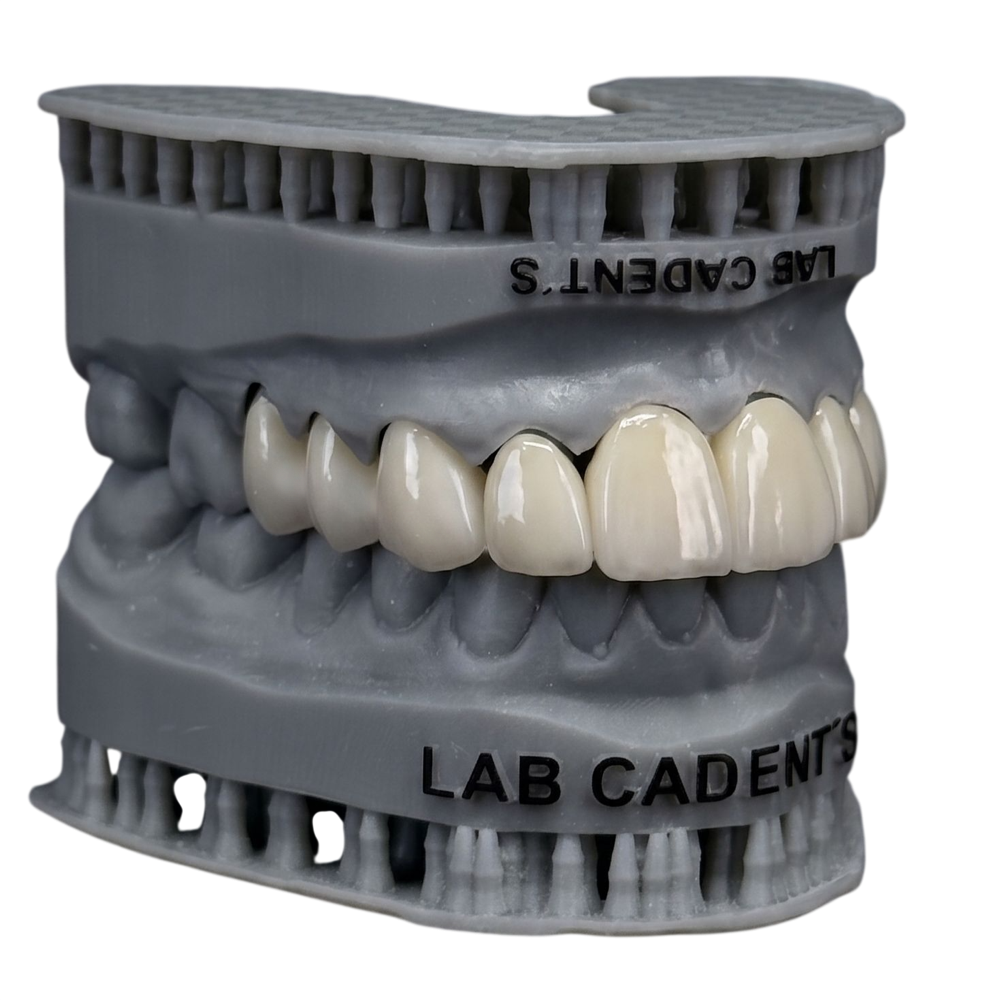 Coroa de dissilicato de lítio (e.max) produzida pela Cadent's Dental Lab em modelo dental