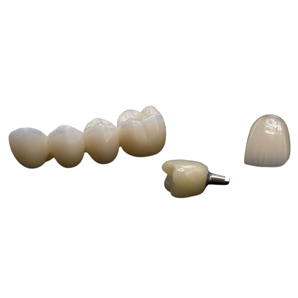 Próteses sobre implante: ponte, coroa unitária e coroa com abutment metálico produzidos pela Cadent's Dental Lab
