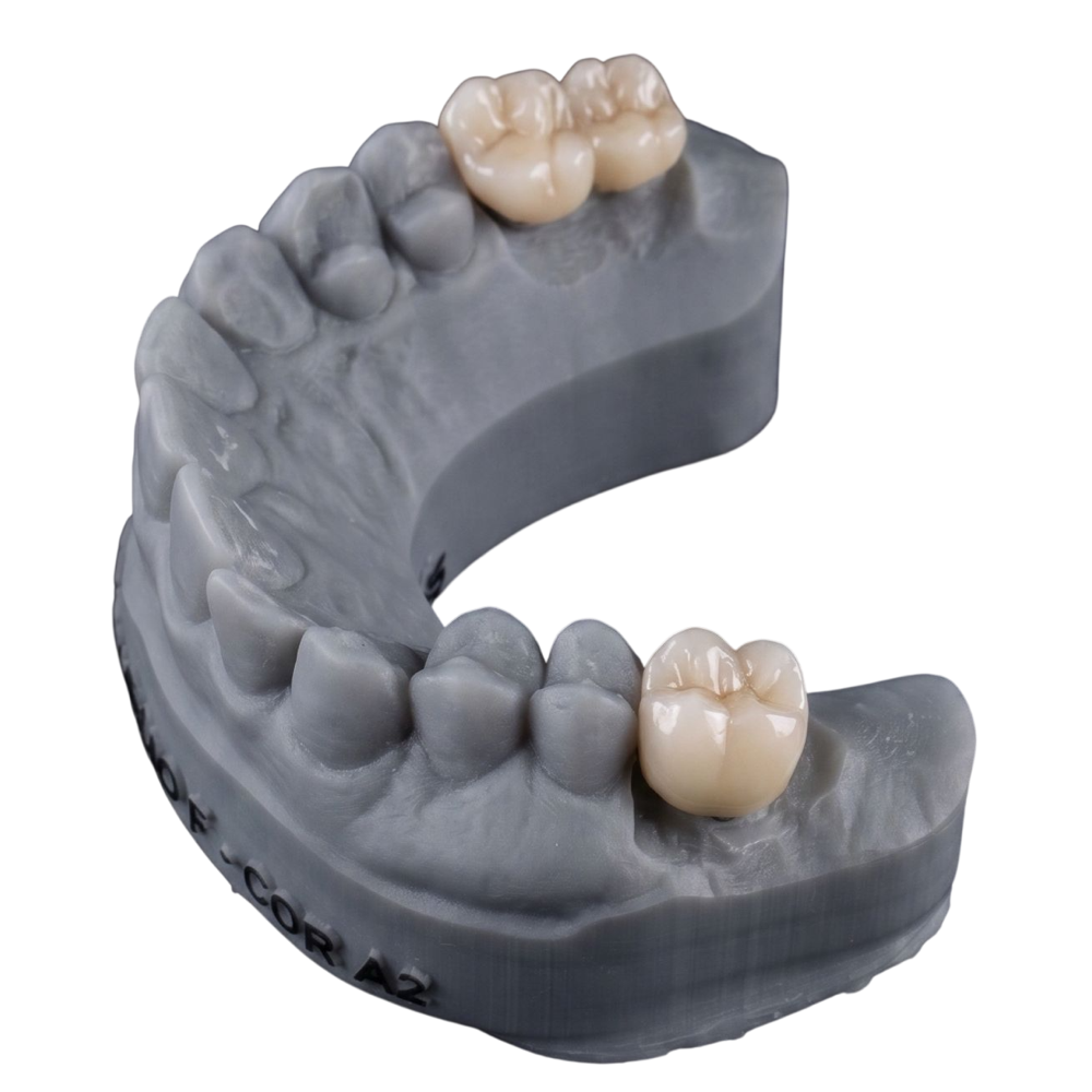 Coroa de zircônia produzida pela Cadent's Dental Lab em modelo dental impresso